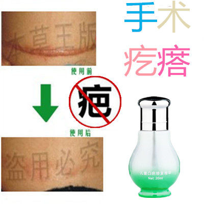 祛疙瘩儿童增生性凸起手术剖宫产刀伤巴痕激光缝针抓伤摔伤撞伤疤