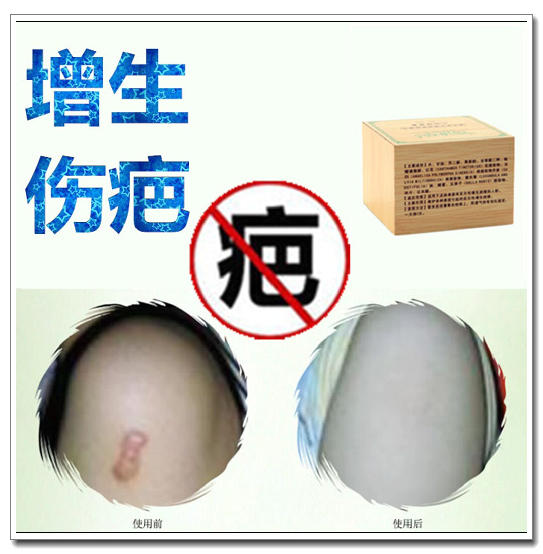 正品修复脸部抓伤疤痕灵的药膏去除缝针软化手术增生性凸起硬疙瘩