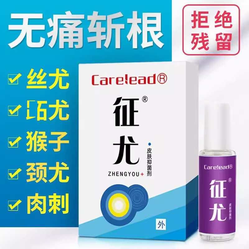 征尤去除尤瘊祛除神器