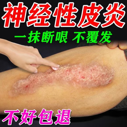 治疗神经性皮炎去祛外用膏皮肤病癣藓湿疹真菌感染顽固无激素