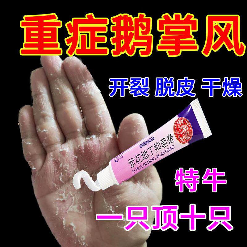治疗鹅掌风专用药干裂脱皮止痒抑菌膏手足癣鹅掌风癣药膏真菌感染