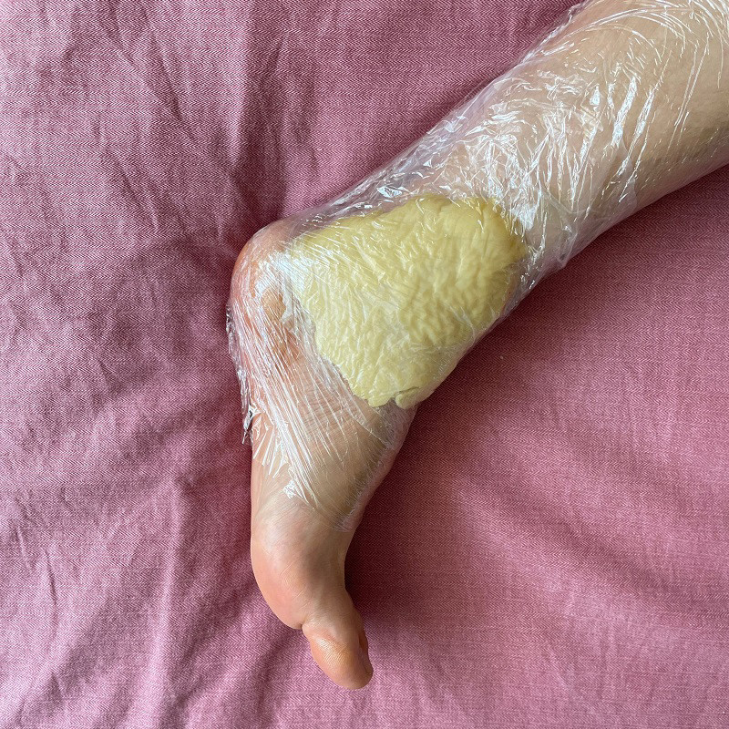 蜂蜡疗法热敷软组织扭伤骨折粘连后期康复家用自制蜡饼刷蜡蜂疗后
