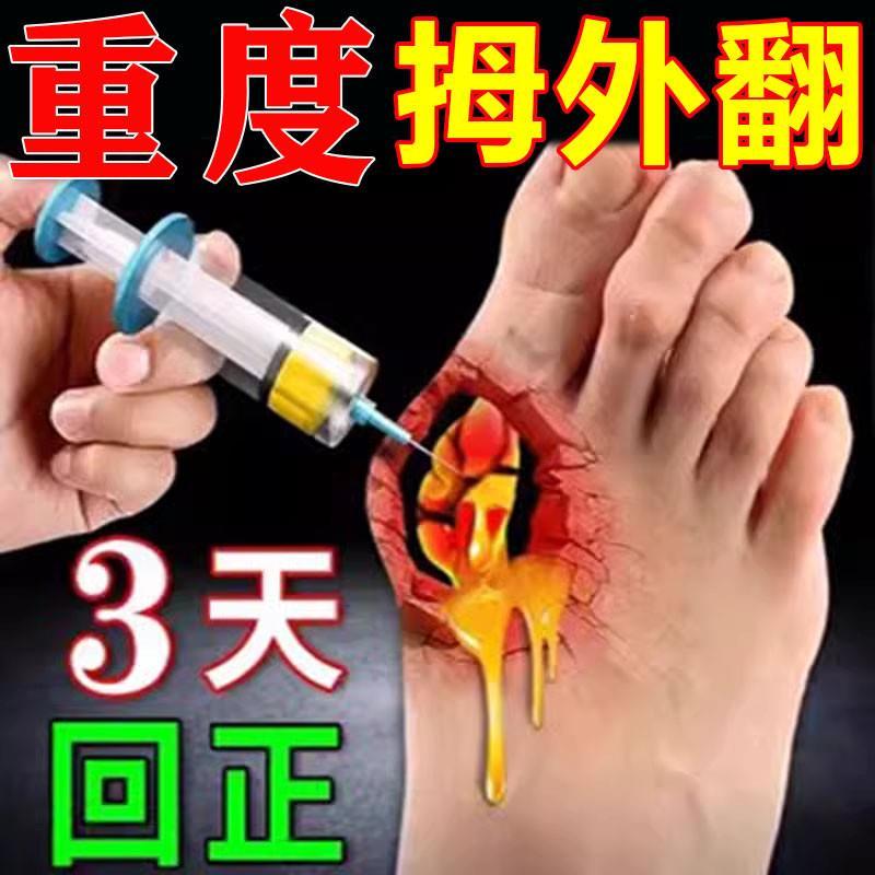 拇外翻矫正器女士大脚趾大脚骨矫正药膏贴脚趾重叠