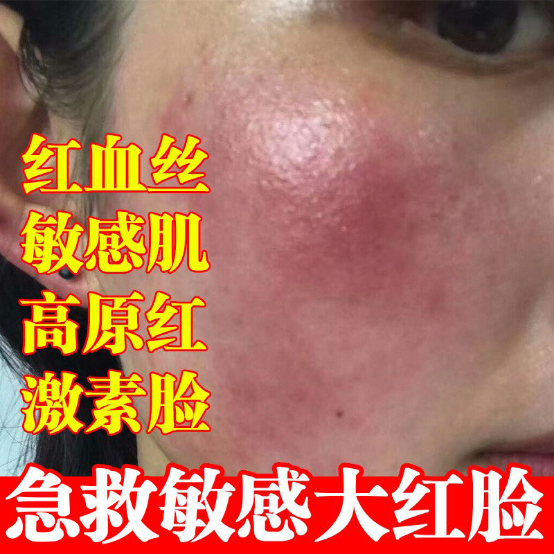 积雪草面膜官方正品补水保湿敏感肌修复肌肤屏障脸部泛红血丝男女