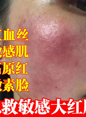 积雪草面膜修复红血丝过敏损伤