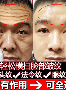 祛除皱纹神器抬头纹去除男士