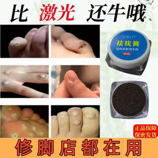跖疣专用膏去除血胞刺祛泡鸡眼贴寻常疣根肉刺瘊子趾足部老茧神器