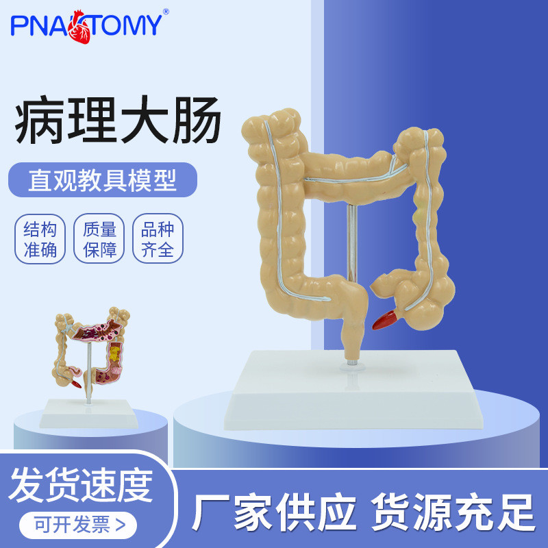 教学仿真结肠病理模型 大肠病变模型 肠道疾病 人体结肠病变模型