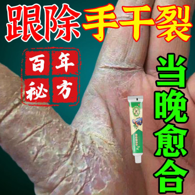 手脚干裂膏起皮干燥手脚脱皮开裂脚后跟真菌感染防裂手足藓药膏
