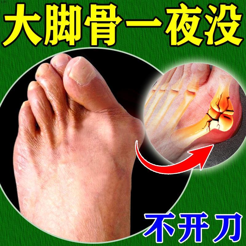 拇指外翻矫正贴大脚骨脚趾重叠专用拇指外翻矫正拇外翻神器特效药