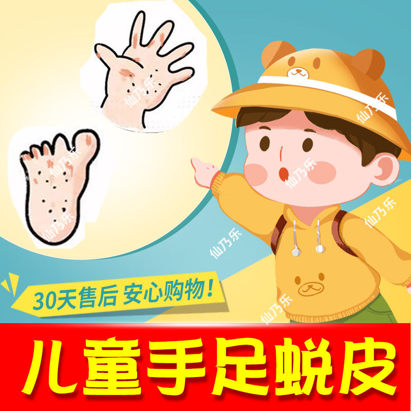 专治手脱皮药膏儿童手指真菌感染手脚干裂开蜕皮干燥起皮手藓足藓