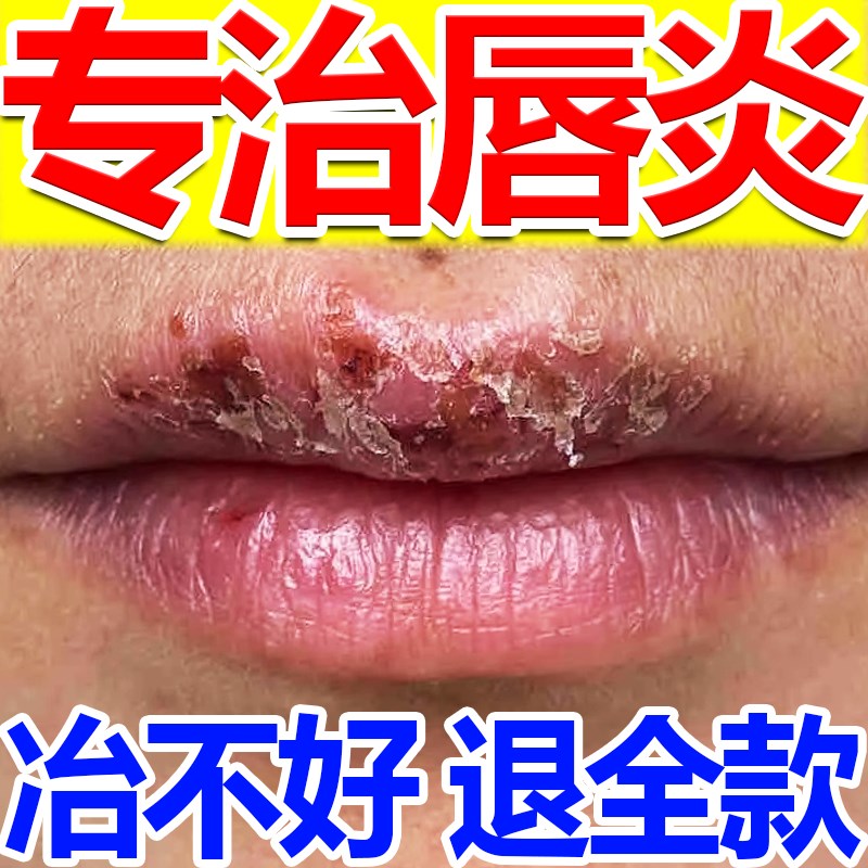 口周唇炎润唇膏修护唇炎唇膏嘴唇干裂脱皮嘴巴干燥起皮烂嘴角开裂