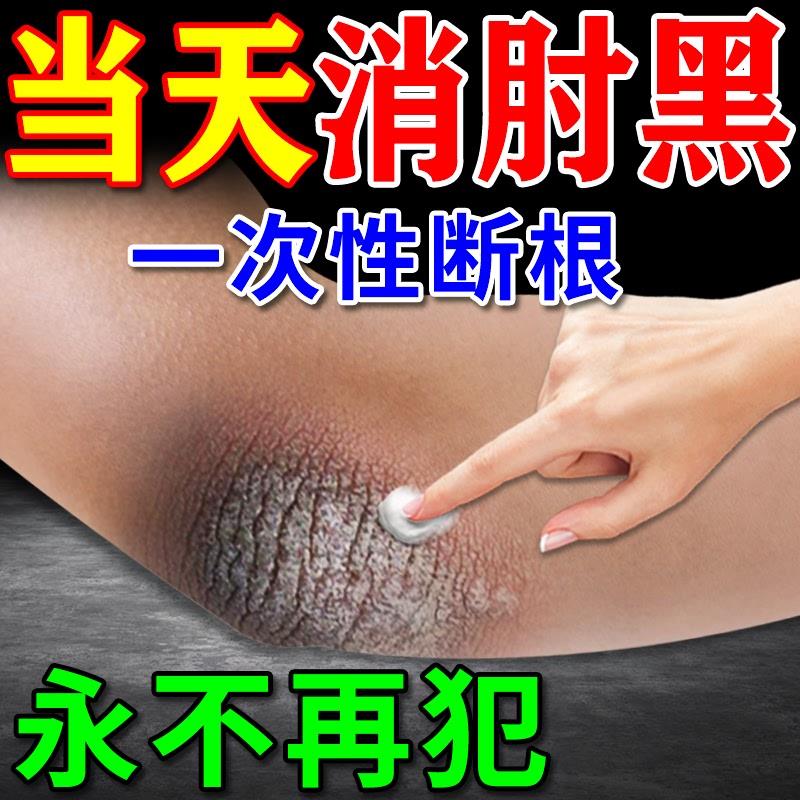 胳膊肘去黑去死皮神器皮肤黑色素沉淀去除手肘发黑肘膝美颜净化素