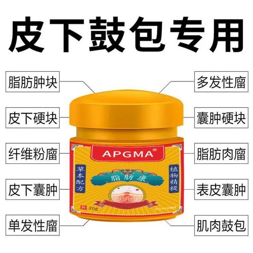 香港脂肪瘤一涂灵专消皮下肿块硬块单发性多发性脂肪瘤去粉瘤囊肿
