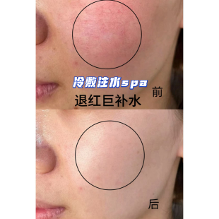 厚脸皮光感莹润面膜 项目后可用 第四代冰凝膜布高纯蓝铜肽强修护