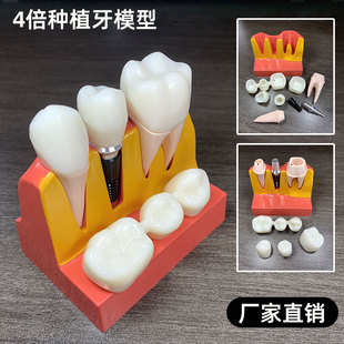 4倍种植解说模型牙科口腔牙齿模型牙冠可拆卸种植钉展示模型教具