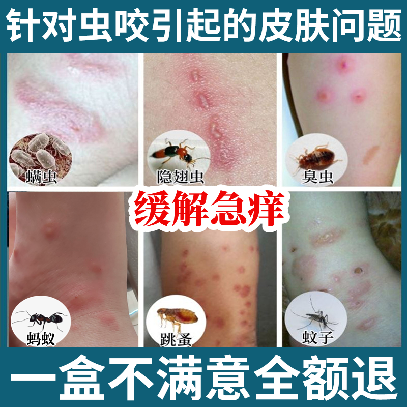 治疗红蚂蚁咬伤被隐刺虫叮咬专用膏止痒臭虫子跳蚤螨虫咬外用药膏