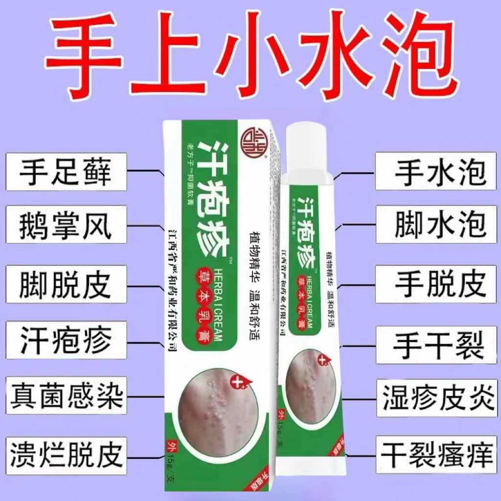 汗泡疱疹药膏手上起小水泡手痒汗状疱疹止痒汉状真菌感染专用软膏