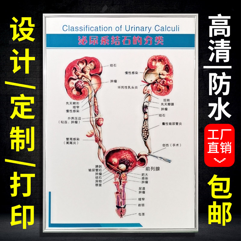 定制挂图体外碎石 肾结石解剖图 泌尿生殖系统解刨口咽部图解墙贴