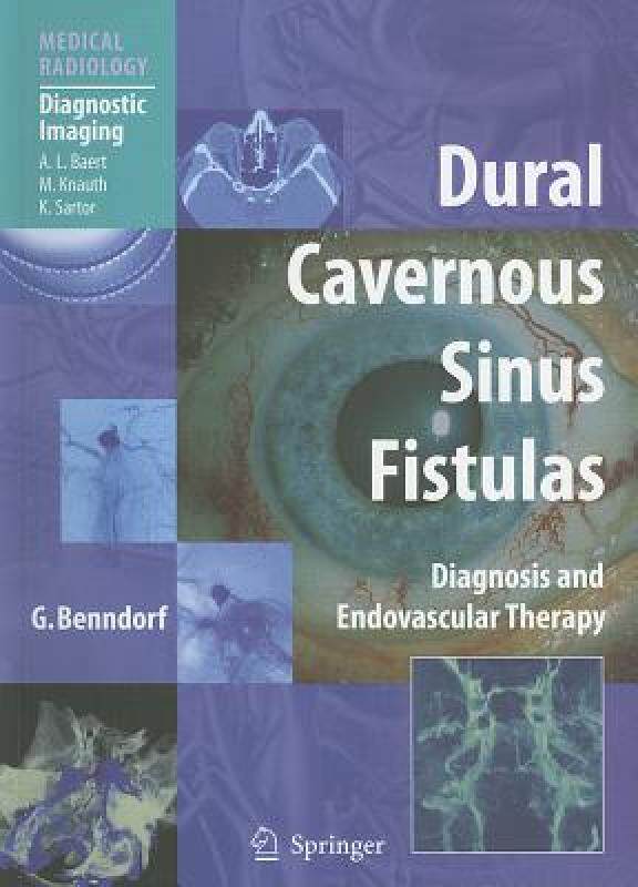 【预售】Dural Cavernous Sinus Fistulas: Diagnosis and