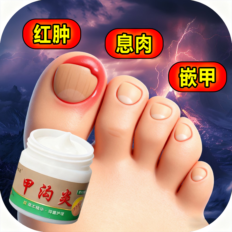 甲沟脚指甲疼大拇指往肉里长销肿感染发红肿化脓脚指甲止痛膏