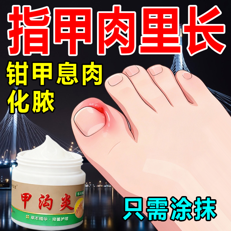 甲沟脚指甲疼大拇指往肉里长销肿感染发红肿化脓脚指甲止痛膏