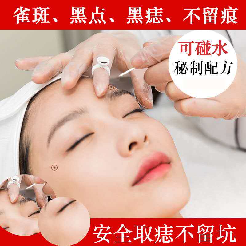 取痣黑点药水无痕正品黑痣去痦子点斑膏雀斑去斑脸部痣修复神器笔