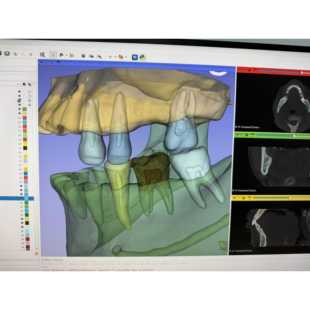 三维重建AI环境CBCT/CT数据单颗牙齿颌骨牙髓神经管STL零基础培训