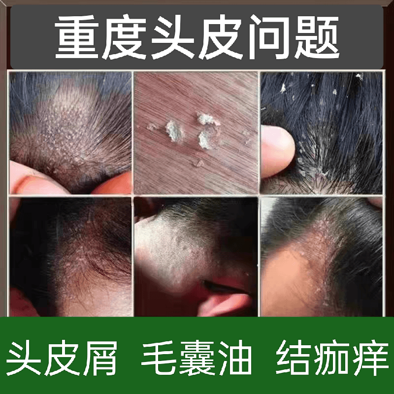 头皮屑多去头藓脂溢性皮炎去屑止痒头皮屑抑菌毛囊炎红疙瘩抑菌乳