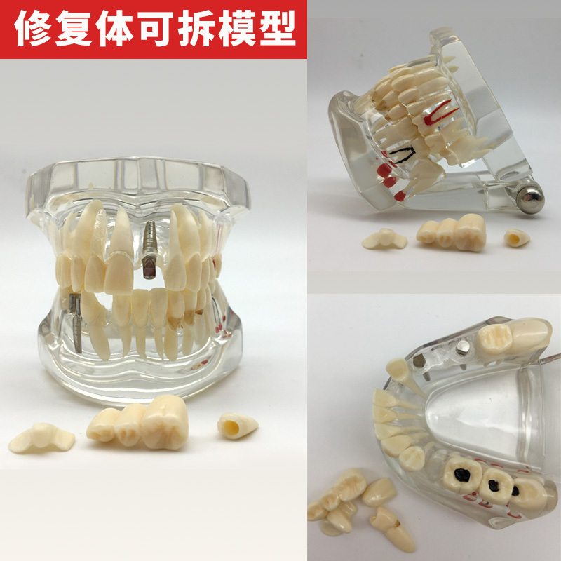 牙模口腔模型成人牙科教学模型齿科口腔教学齿科修复体可拆牙模型
