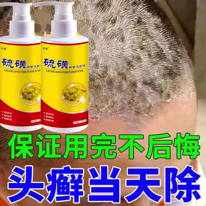 硫磺洗发水头皮痒头皮癣瘌痢头头屑毛囊头藓专用药水洗发膏真菌