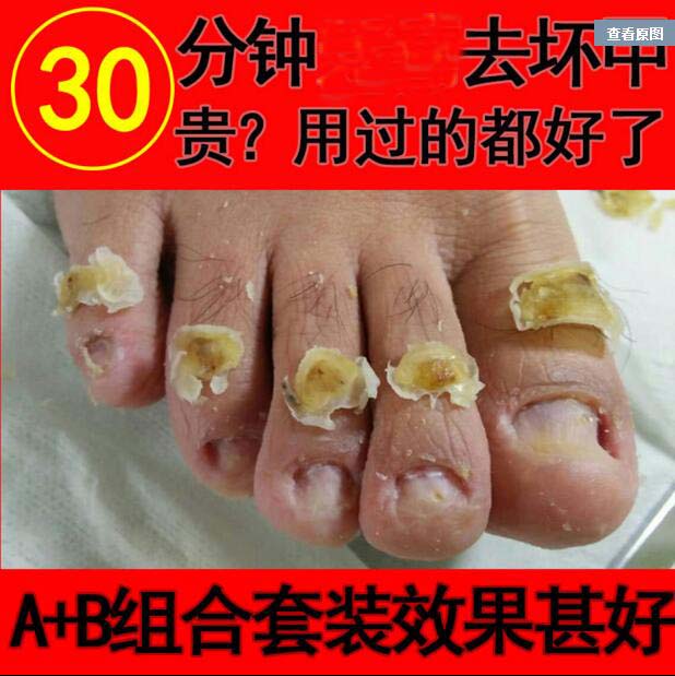 正品包邮灰色甲专用液套装亮甲正品软甲膏脱甲油去除灰