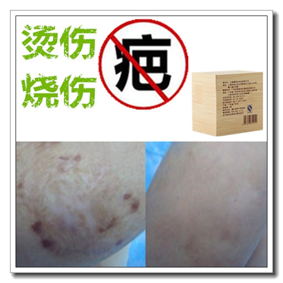 药用去除儿童烟烫增生性突疤疙瘩祛烧伤巴药膏疤痕印正品淡化色素