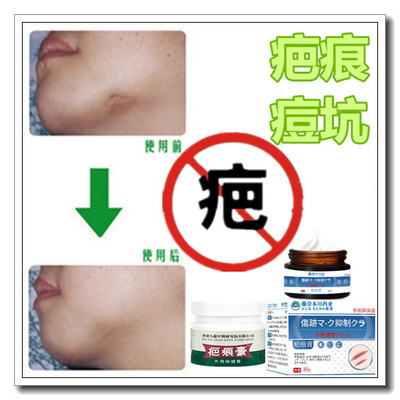 祛疙瘩修复增生性凸疤手术缝针剖腹产伤疤痕印体质抓伤摔伤撞伤液