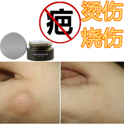 祛除烧伤增生性体质修复软化烟烫疙瘩去凹凸烟疤痕印淡化色素药膏