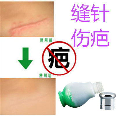 奇迹草本祛缝针产后剖宫产凹凸疤冻疮疙瘩开刀割伤疤痕印烟烫药液在类目 彩妆/香水/美妆工具, 遮瑕中 - 来自Buy2taobao.com提供专业的淘宝代购服务