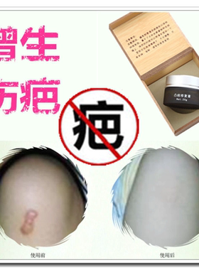 祛除儿童脸面部黑色素沉着修复霜去手术凹凸起烫伤疤痕正品平巴贴