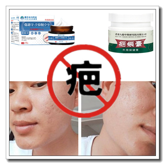 祛手术后烟烫增生性突出疙瘩烧伤药烟烫软化疤痕体质去碰伤精华液