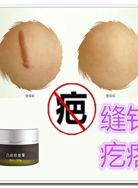 去除脸部抓伤疤痕灵的药膏修复手术增生性老疤淡化缝针凹凸起疙瘩