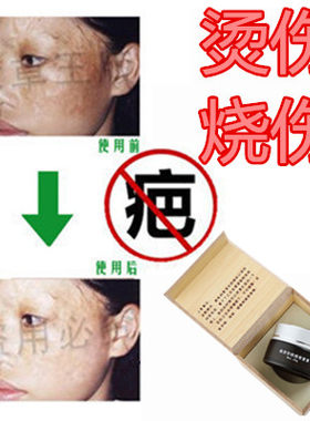 修复祛凹凸开刀伤疤痕印消除去增生性冻疮疙瘩手术产后摔伤药乳液