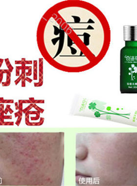 产品去除前胸痤疮后背部额头封闭合性青春痘痘舒缓面部粉刺油脂粒