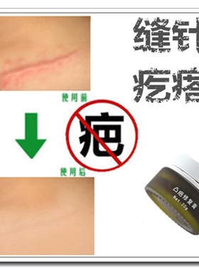 去除脸部伤疤痕的药淡化黑色素沉淀修复药膏正品祛儿童专用消平贴