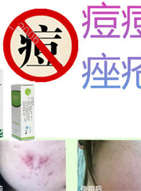 正品祛除前胸豆印印后背部额头封闭合性青春痘痘印舒缓痤疮油脂粒
