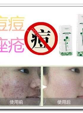 去除脸上部闭口粉刺深层清洁湿敷水洗面奶消祛额头痘疤痘印药膏贴