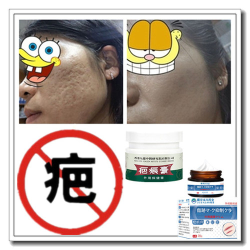 去儿童增生性体质凸出手术后疙瘩剖宫产刮伤疤痕印缝针抓伤精华液
