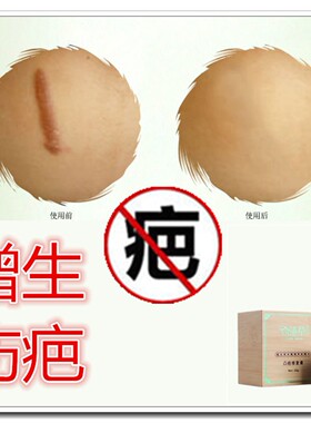 去除儿童脸面部烧烫伤疤痕的药淡化黑色素暗沉专用凹凸克星修复膏