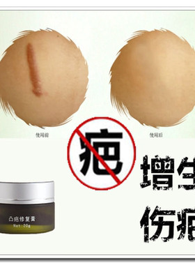 去除手术缝针印烧烫伤疤痕灵修复脸部凹凸起软化增生性正品的药膏
