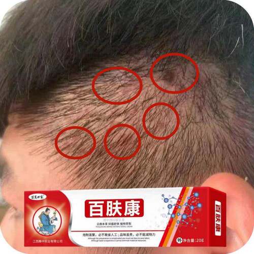 百肤康头皮起红疙瘩脓包头部鼓包毛囊草本萃取无激素舒缓草本乳膏