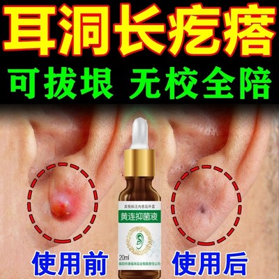 耳洞增生疙瘩护理液耳朵发炎专用药膏清洁消炎去除疤痕增生凸起