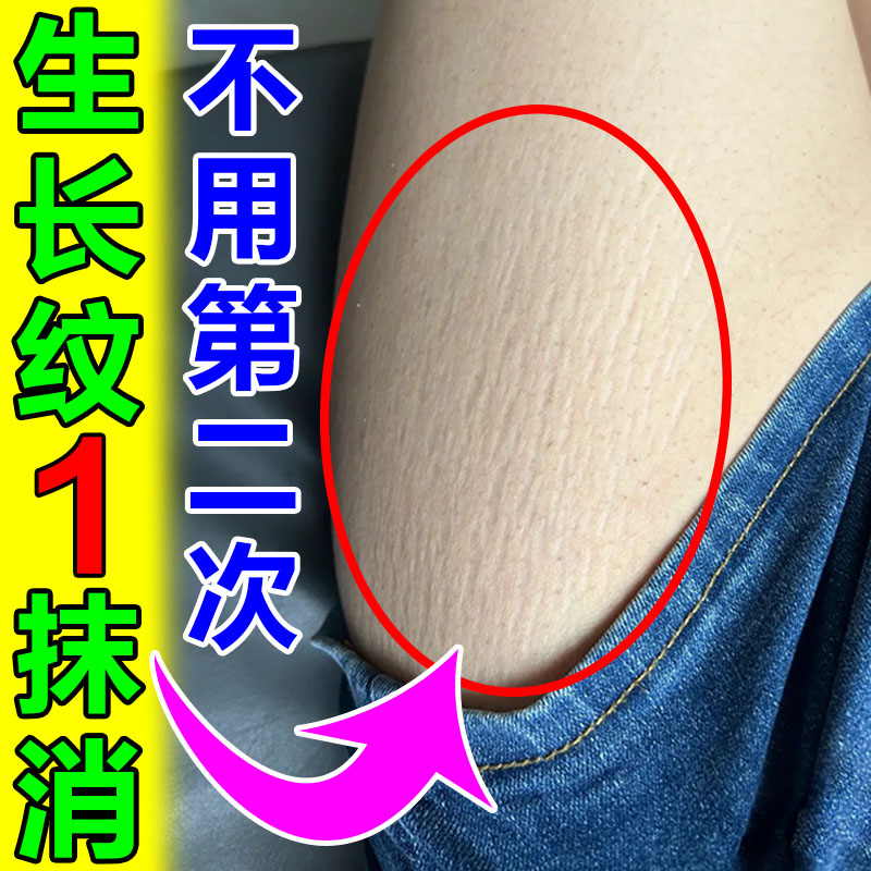 生长纹消除大腿学生身体乳去肥胖纹修复霜妊娠纹淡化男女通用精油